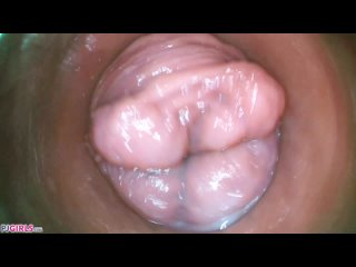 silvia black endoscopic 2021-08-14